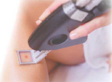 激光衍射元件DOE在激光醫(yī)美行業(yè)的應(yīng)用